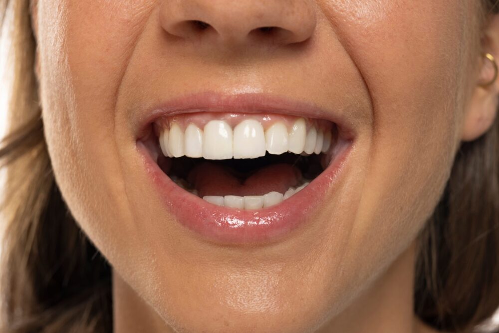 What to Expect from a Full Mouth Reconstruction in Greenville